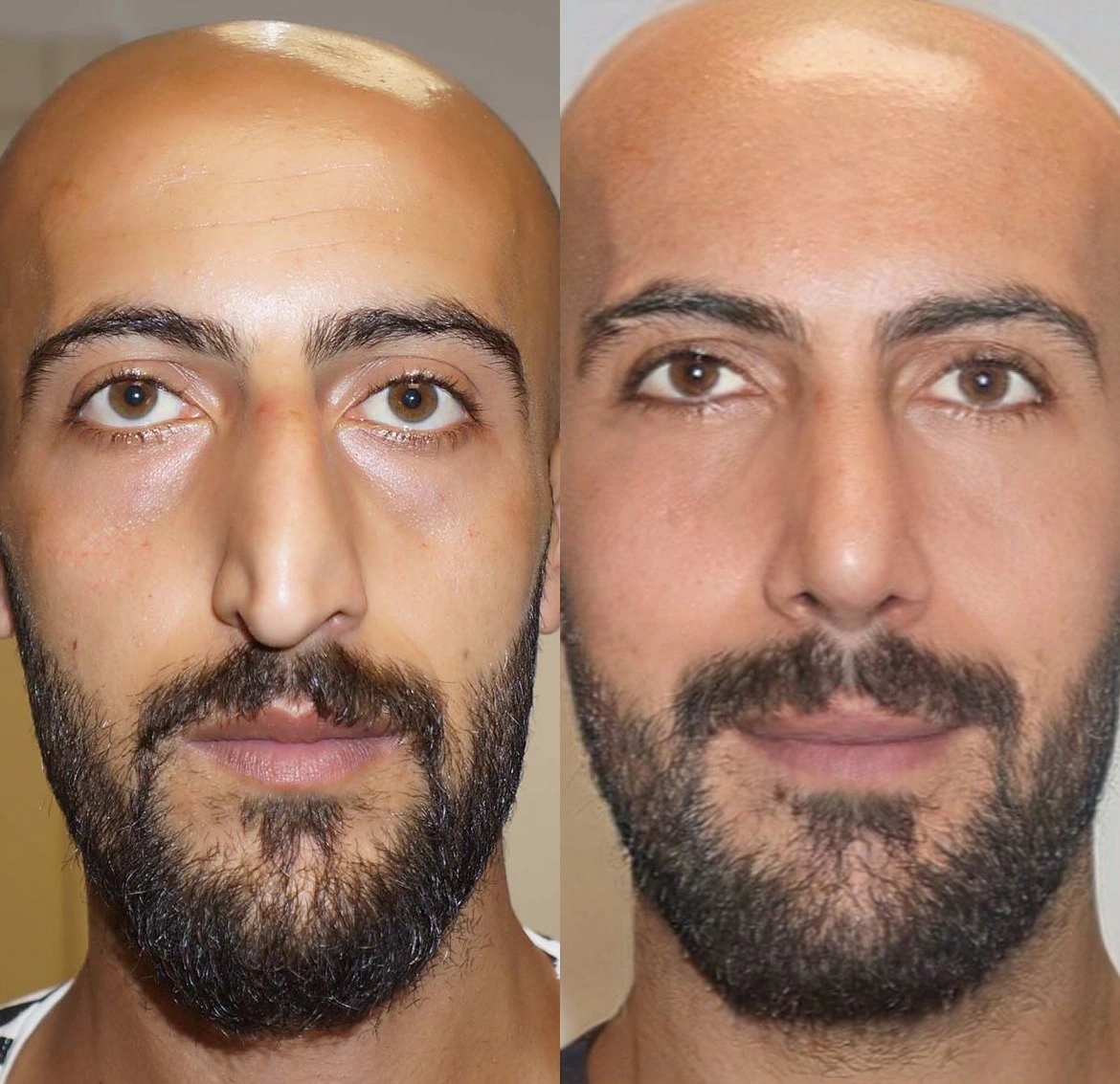 23 Mind-Blowing Transformations from Plastic Surgery