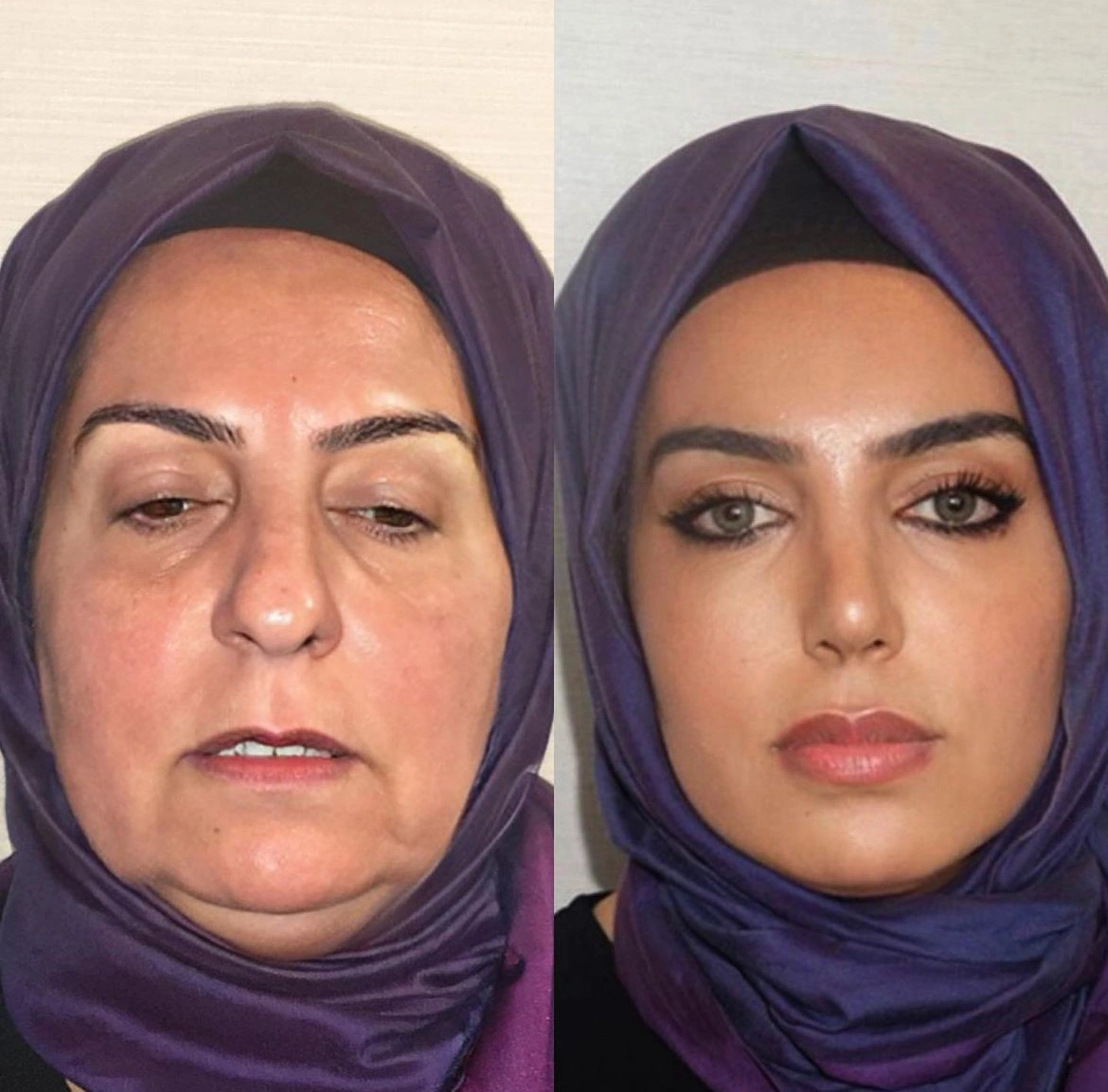 23 Mind-Blowing Transformations from Plastic Surgery
