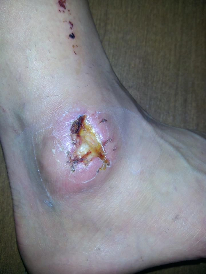 The Experience of Being Bitten by a Brown Recluse Spider