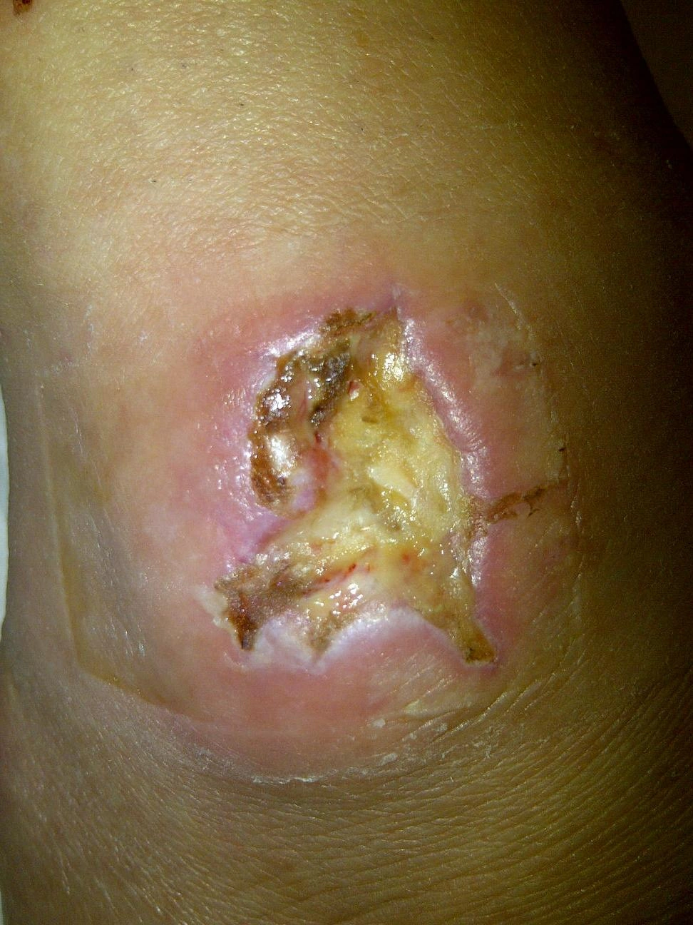 The Experience of Being Bitten by a Brown Recluse Spider