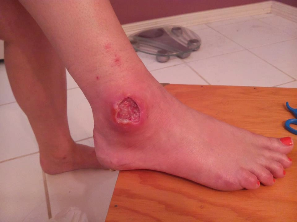 The Experience of Being Bitten by a Brown Recluse Spider