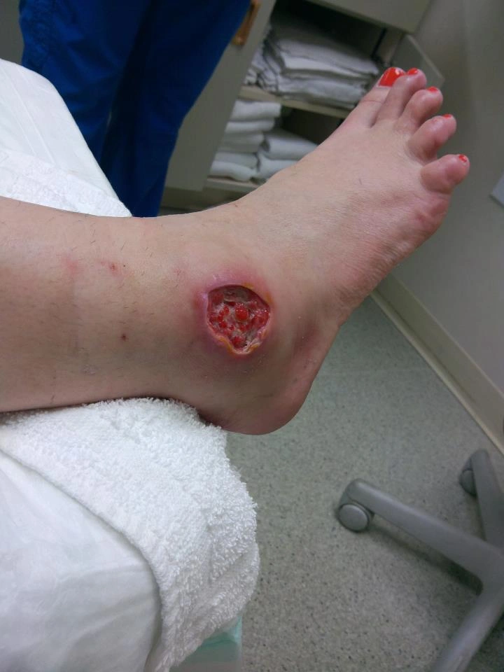 The Experience of Being Bitten by a Brown Recluse Spider