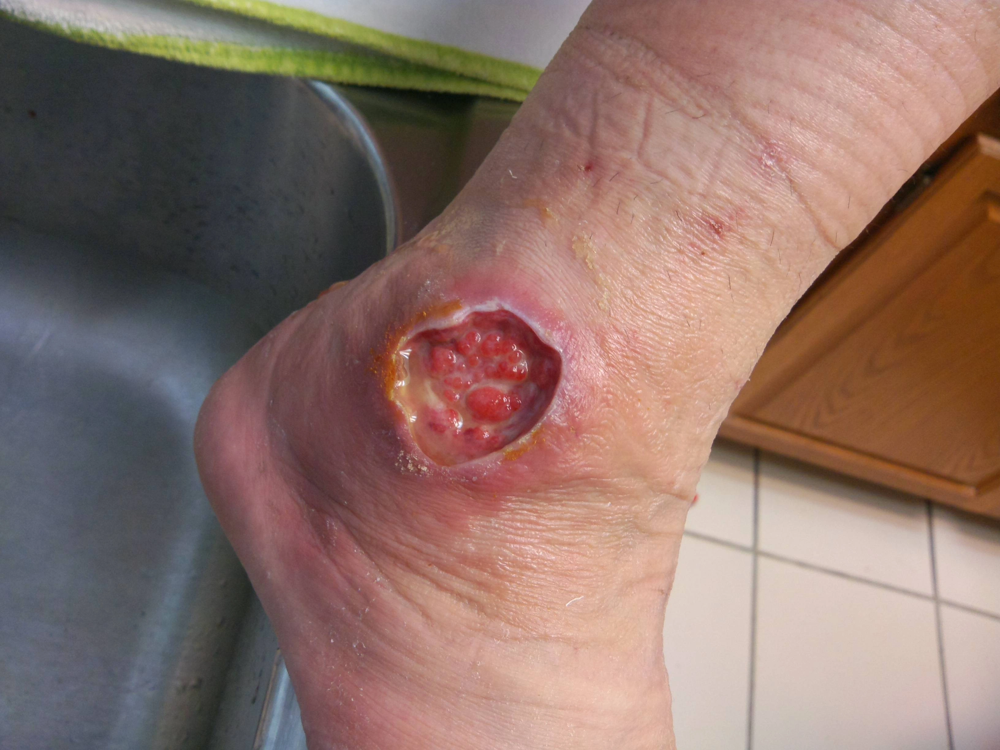 The Experience of Being Bitten by a Brown Recluse Spider