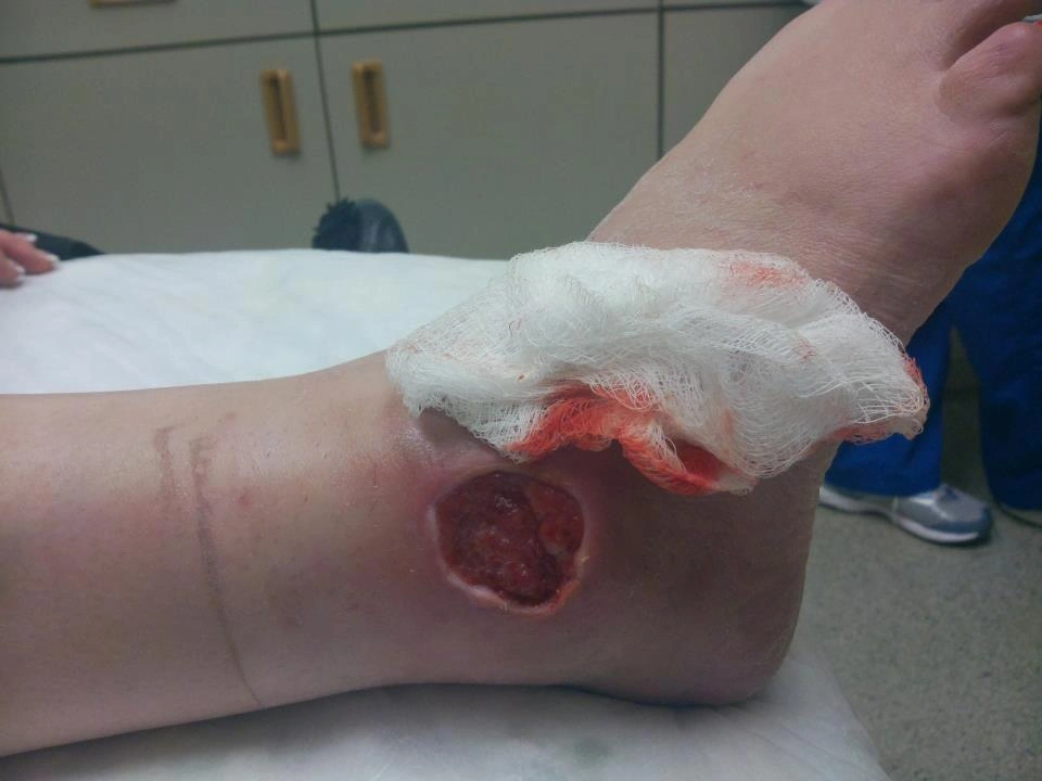 The Experience of Being Bitten by a Brown Recluse Spider