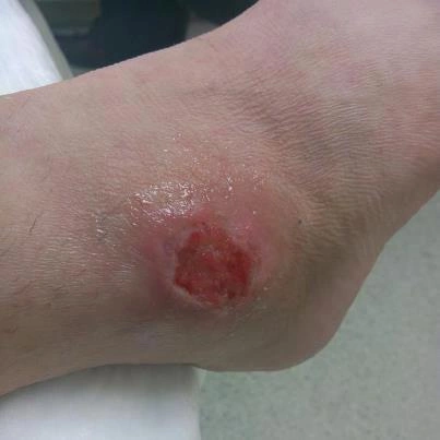 The Experience of Being Bitten by a Brown Recluse Spider