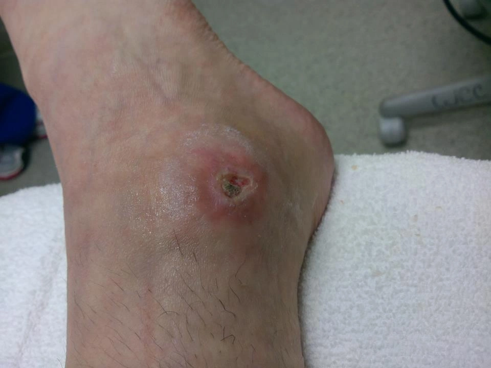 The Experience of Being Bitten by a Brown Recluse Spider