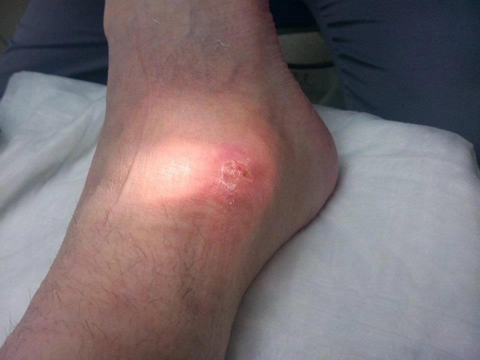 The Experience of Being Bitten by a Brown Recluse Spider