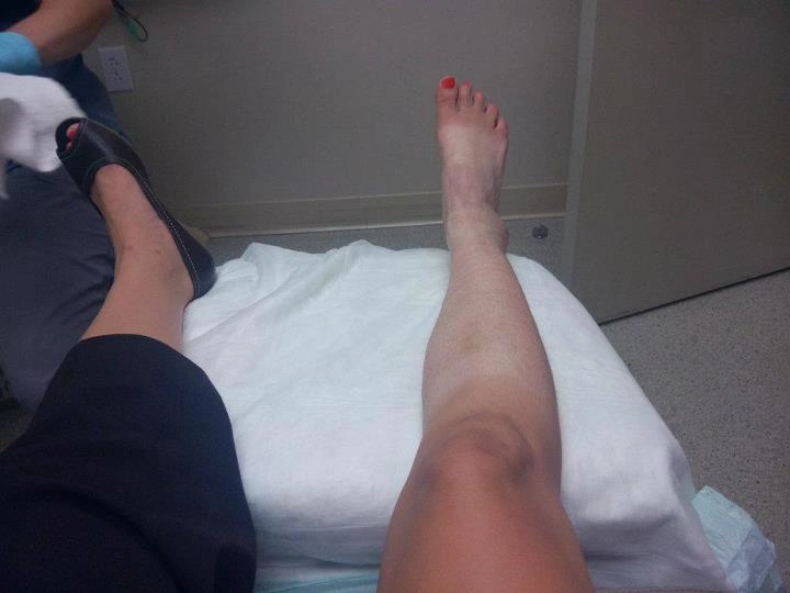 The Experience of Being Bitten by a Brown Recluse Spider