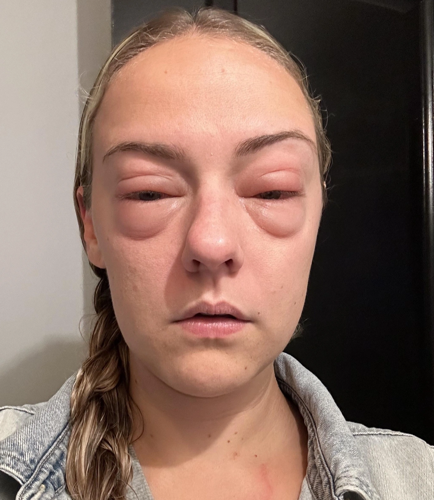 40 Individuals with Severe Allergic Reactions: A Visual Compilation