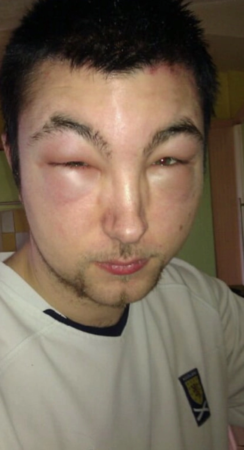 40 Individuals with Severe Allergic Reactions: A Visual Compilation